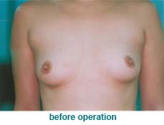 plastic-surgery-breast-augmentation 