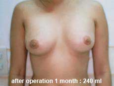 plastic-surgery-breast-augmentation 