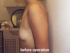 plastic-surgery-breast-augmentation 