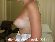plastic-surgery-breast-augmentation 