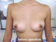 plastic-surgery-breast-augmentation 
