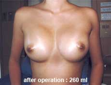 plastic-surgery-breast-augmentation 