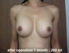 plastic-surgery-breast-augmentation 