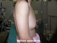 plastic-surgery-breast-augmentation 