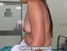 plastic-surgery-breast-augmentation 