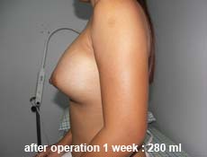 plastic-surgery-breast-augmentation 