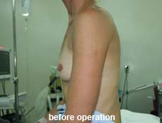 plastic-surgery-breast-augmentation 