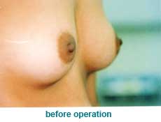 plastic-surgery-breast-augmentation 