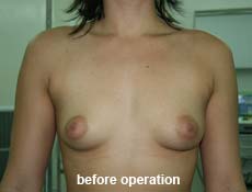 plastic-surgery-breast-augmentation 