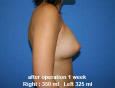 plastic-surgery-breast-augmentation 