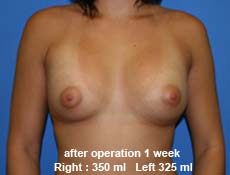 plastic-surgery-breast-augmentation 