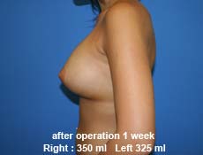 plastic-surgery-breast-augmentation 