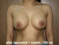 plastic-surgery-breast-augmentation