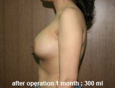 plastic-surgery-breast-augmentation