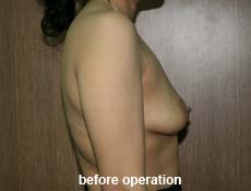 plastic-surgery-breast-augmentation