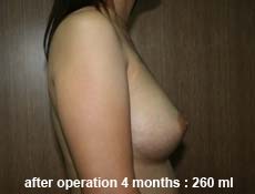 plastic-surgery-breast-augmentation