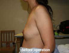 plastic-surgery-breast-augmentation