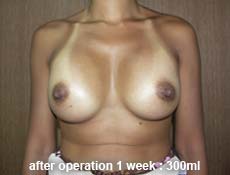 plastic-surgery-breast-augmentation