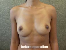 plastic-surgery-breast-augmentation