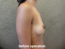 plastic-surgery-breast-augmentation