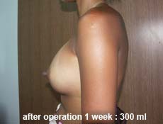 plastic-surgery-breast-augmentation