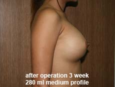 plastic-surgery-breast-augmentation