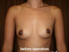 plastic-surgery-breast-augmentation