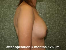 plastic-surgery-breast-augmentation