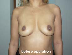 plastic-surgery-breast-augmentation 