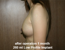 plastic-surgery-breast-augmentation 