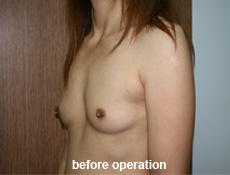 plastic-surgery-breast-augmentation 