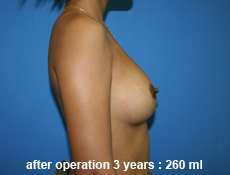plastic-surgery-breast-augmentation 