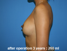 plastic-surgery-breast-augmentation 