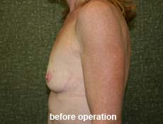 plastic-surgery-breast-augmentation 