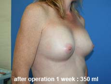 plastic-surgery-breast-augmentation 