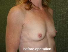plastic-surgery-breast-augmentation 