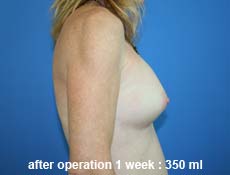 plastic-surgery-breast-augmentation 