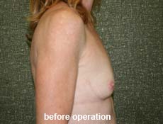 plastic-surgery-breast-augmentation 