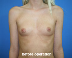 plastic-surgery-breast-augmentation 