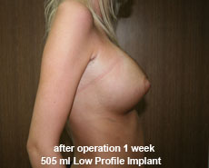 plastic-surgery-breast-augmentation 
