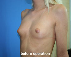plastic-surgery-breast-augmentation 