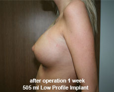 plastic-surgery-breast-augmentation 