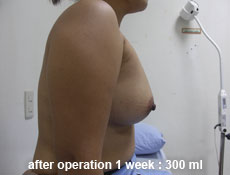 plastic-surgery-breast-augmentation 