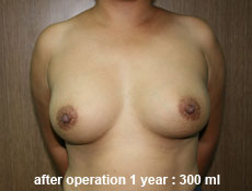 plastic-surgery-breast-augmentation 