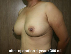 plastic-surgery-breast-augmentation 