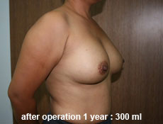 plastic-surgery-breast-augmentation 