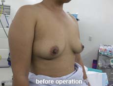plastic-surgery-breast-augmentation 