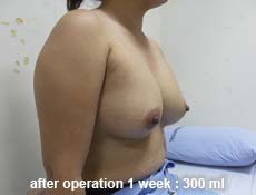 plastic-surgery-breast-augmentation 