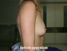 plastic-surgery-breast-augmentation