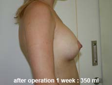 plastic-surgery-breast-augmentation